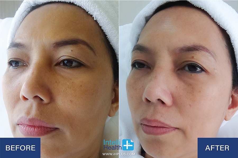 Before-After Facial Rejuvenation Program at IntelliHealthPlus Clinic in Bangkok