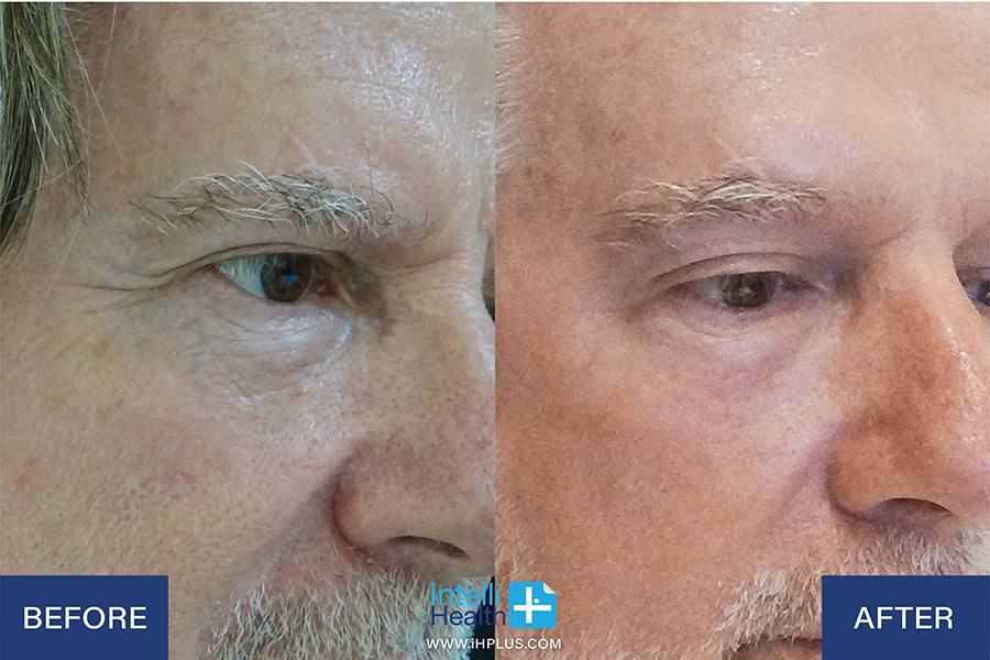 Intellihealth+FB Single_Before-After2