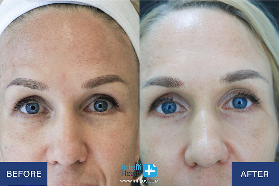 Before-After Facial Rejuvenation Program at IntelliHealthPlus Clinic in Bangkok