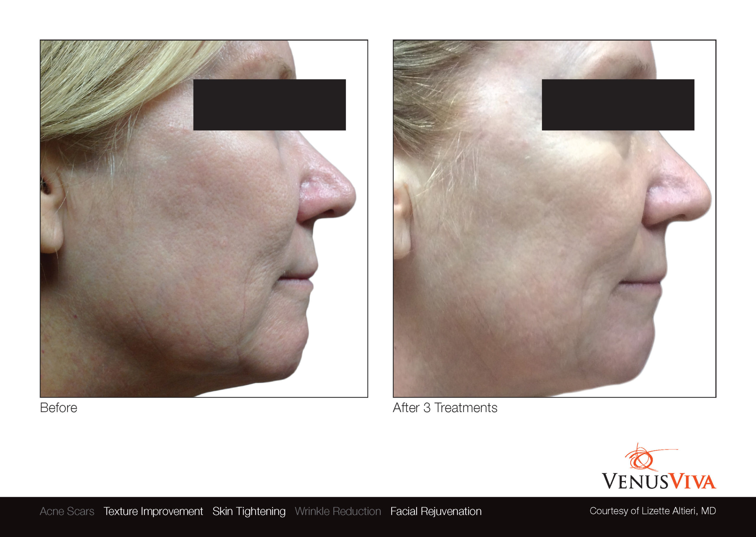skin-resurfacing-austin-venus-viva-before-and-after