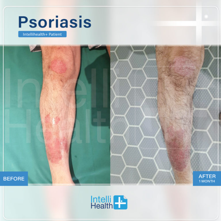 Intellihealth+ PatientPsoriasis Before-After-02