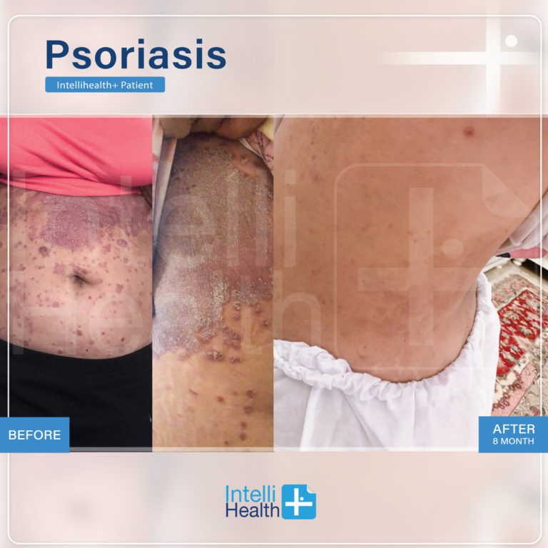 Intellihealth+ PatientPsoriasis Before-After2-01