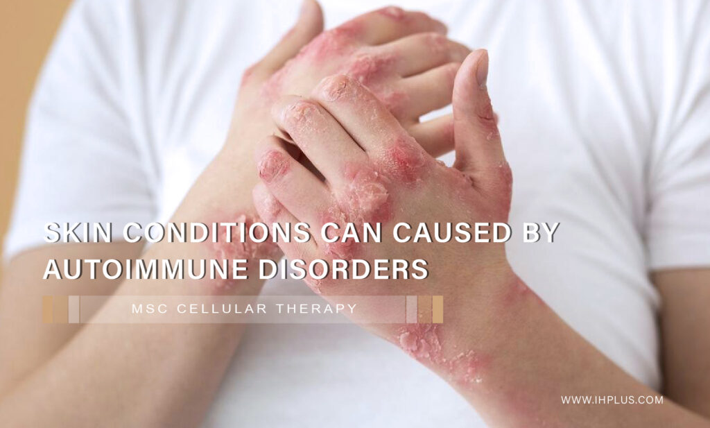 Skin Conditions can be caused by autoimmune disorders, Skin Conditions, Skin Disorders, Skin Disorder treatment in bangkok, Autoimmune Disorder Treatment in bangkok,