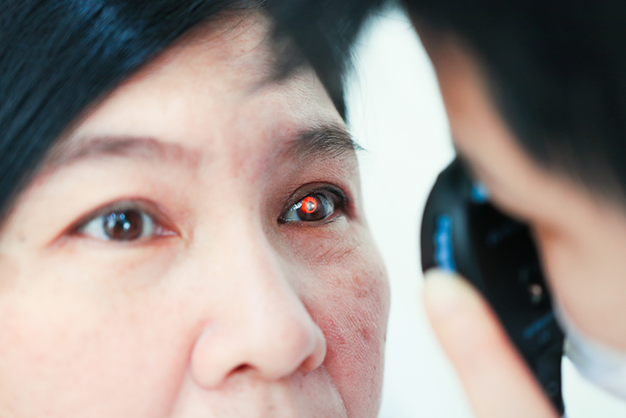 Tratamiento de trastornos oculares y de la visión en la clínica IntelliHealthPlus por StemCells21 en Bangkok, trastornos oculares, tratamiento con células MSC para trastornos oculares,