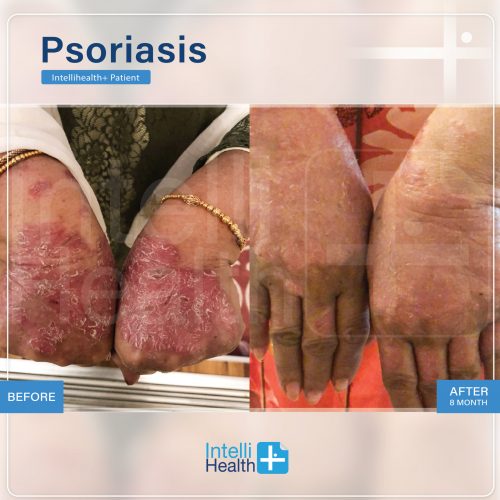 Intellihealth+ PatientPsoriasis Before-After-01