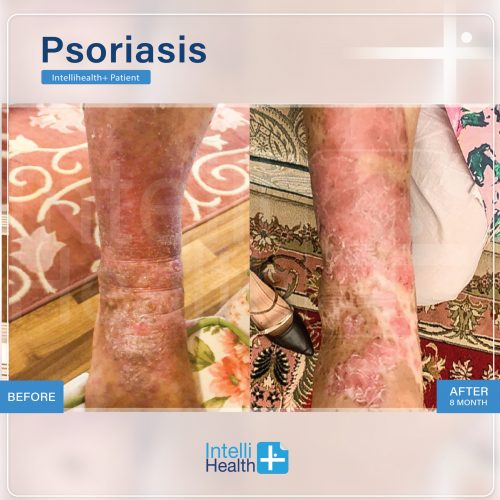 Ihplus Psoriasis patient Before-After-03